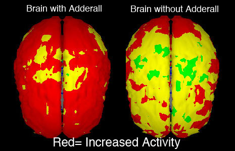 adderall-brain-side-effects1.jpg